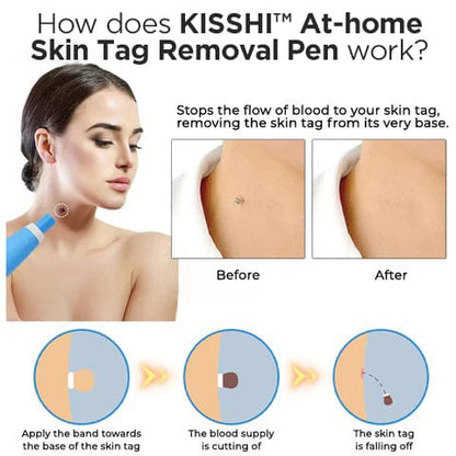 KIT para eliminar verrugas cutáneas en casa KISSHI™